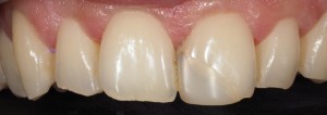 Reconstrucción estética paciente 1 - antes
