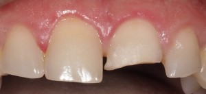 Reconstrucción estética paciente 2 - antes